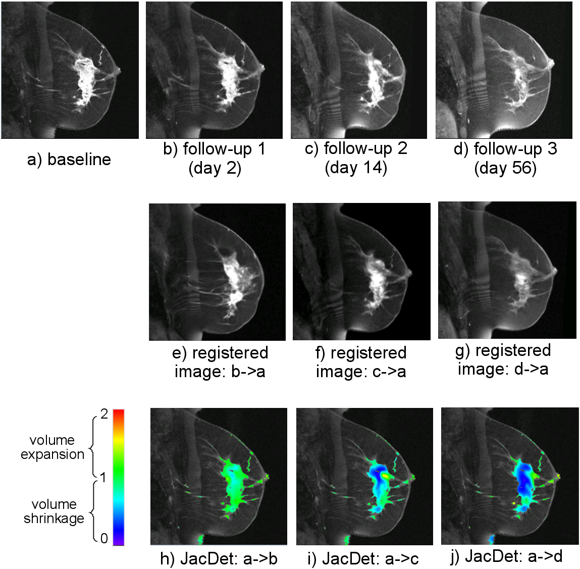 Quantification of the longitudinal cancer of a breast cancer patient, by the Jacobian Determinant maps derived from the DRAMMS-computed deformation.